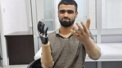 DEMİRİN ELEKTRİK TELLERİNE DEĞMESİYLE HAYATI KARARAN MUHAMMED, 3 MİLYON TL DEĞERİNDEKİ PROTEZ BACAĞINA VE 2 BİYONİK KOLUNA KAVUŞTU