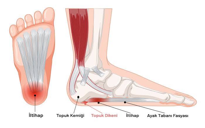 Topuk Dikeni Ağrısında Yük Yönetimi ve Tedavi Planının Önemi